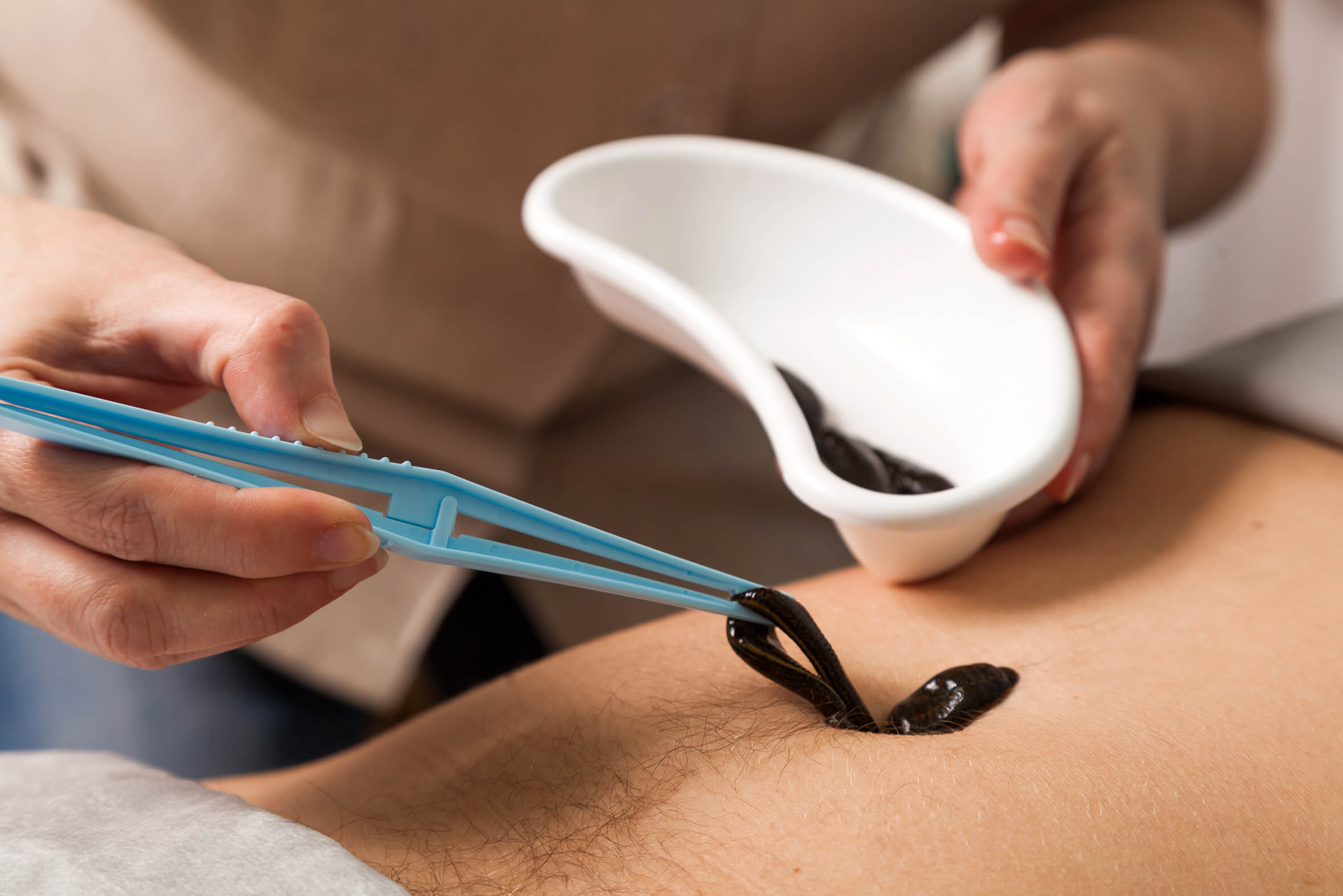 Lodeksa Medical Leeches